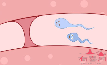 邯郸助孕中介高端群：输卵管近端堵塞会导致不