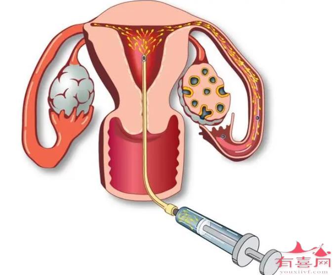 大连助孕机构生殖中心：人工授精对妇女的身体